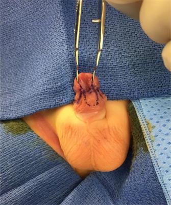 The Megameatus, Intact Prepuce Variant of Hypospadias: Use of the Inframeatal Vascularized Flap for Surgical Correction